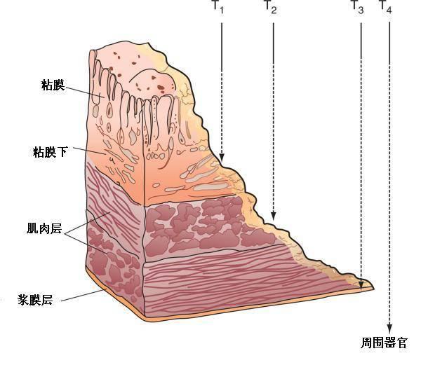 糜烂性胃炎会癌变吗？应该怎么治疗？你想知道的都在这里