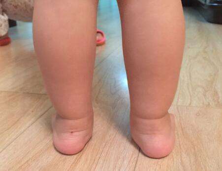 关于儿童足外翻,你误会了多少?后悔科普太晚了