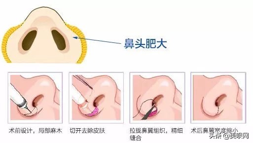 鼻翼缩小有什么神力，小樱花、金南珠等一众明星都在做？