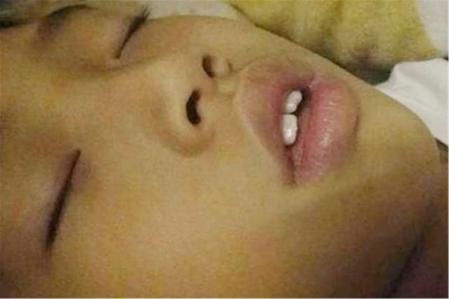 孩子“嘴部”越长越难看，不是环境影响颜值，可能是睡觉的坏习惯