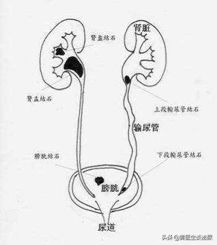 半夜在家被“尿结石”痛醒了怎么办？就诊方案来了