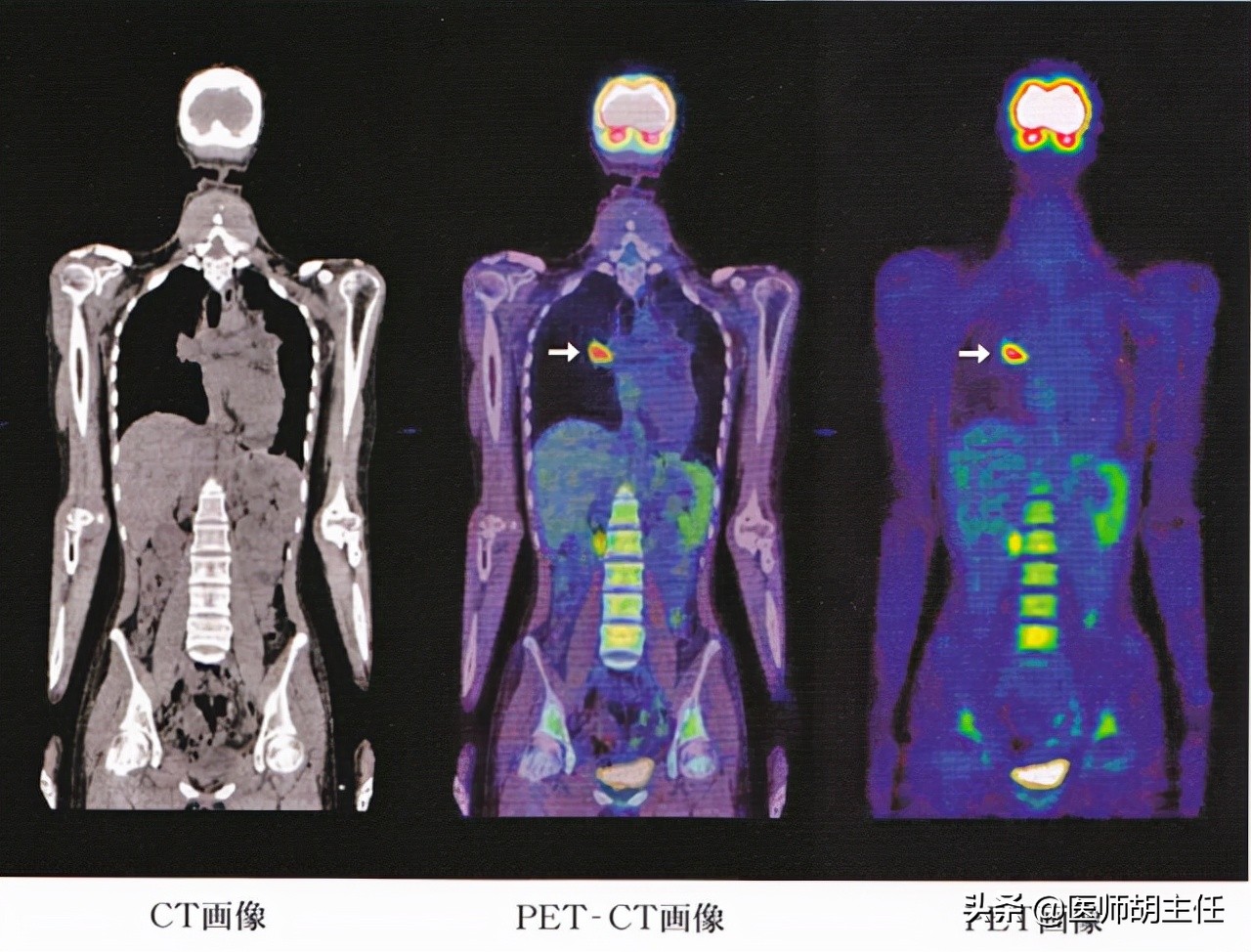 1万一次的PET-CT是什么？值得做吗？