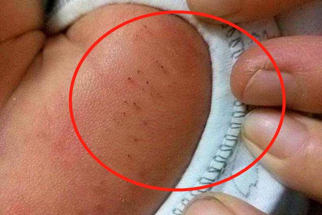 婴儿毛孔粗大的图片(妈妈发现宝宝身上有) - 乐宝宝贝