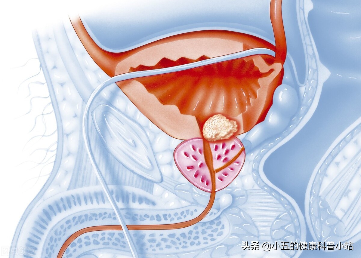 聊一聊治疗慢性前列腺炎的中成药——前列舒通胶囊