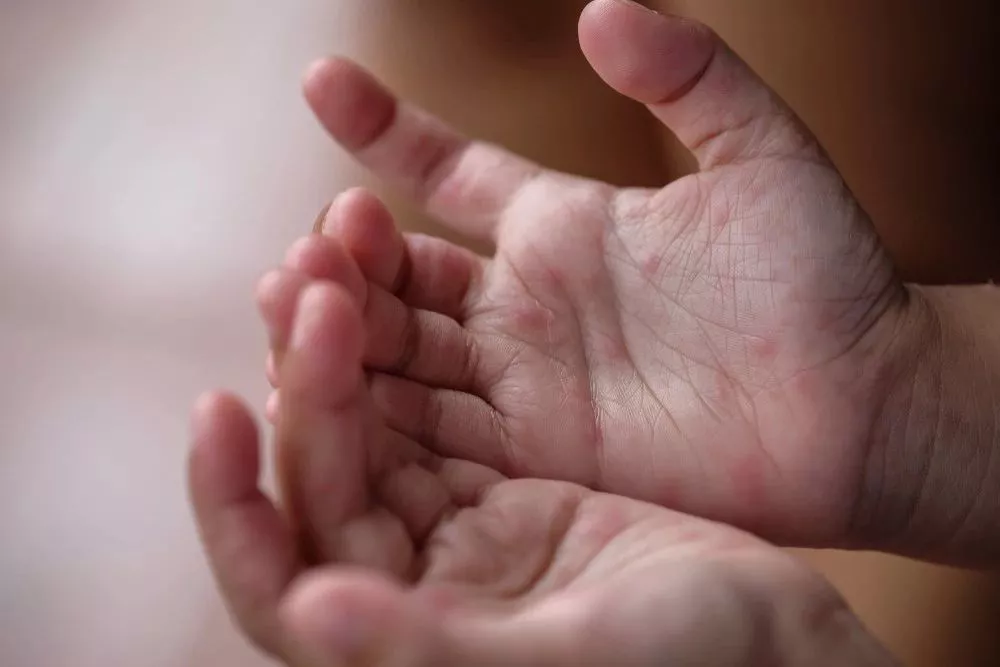 手足口病进入第二个高发期，孩子有这6种症状，需马上就医