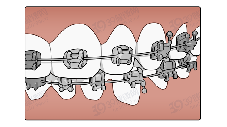 为什么只要戴牙套，牙齿就可以恢复得很整齐？生动展示矫正过程
