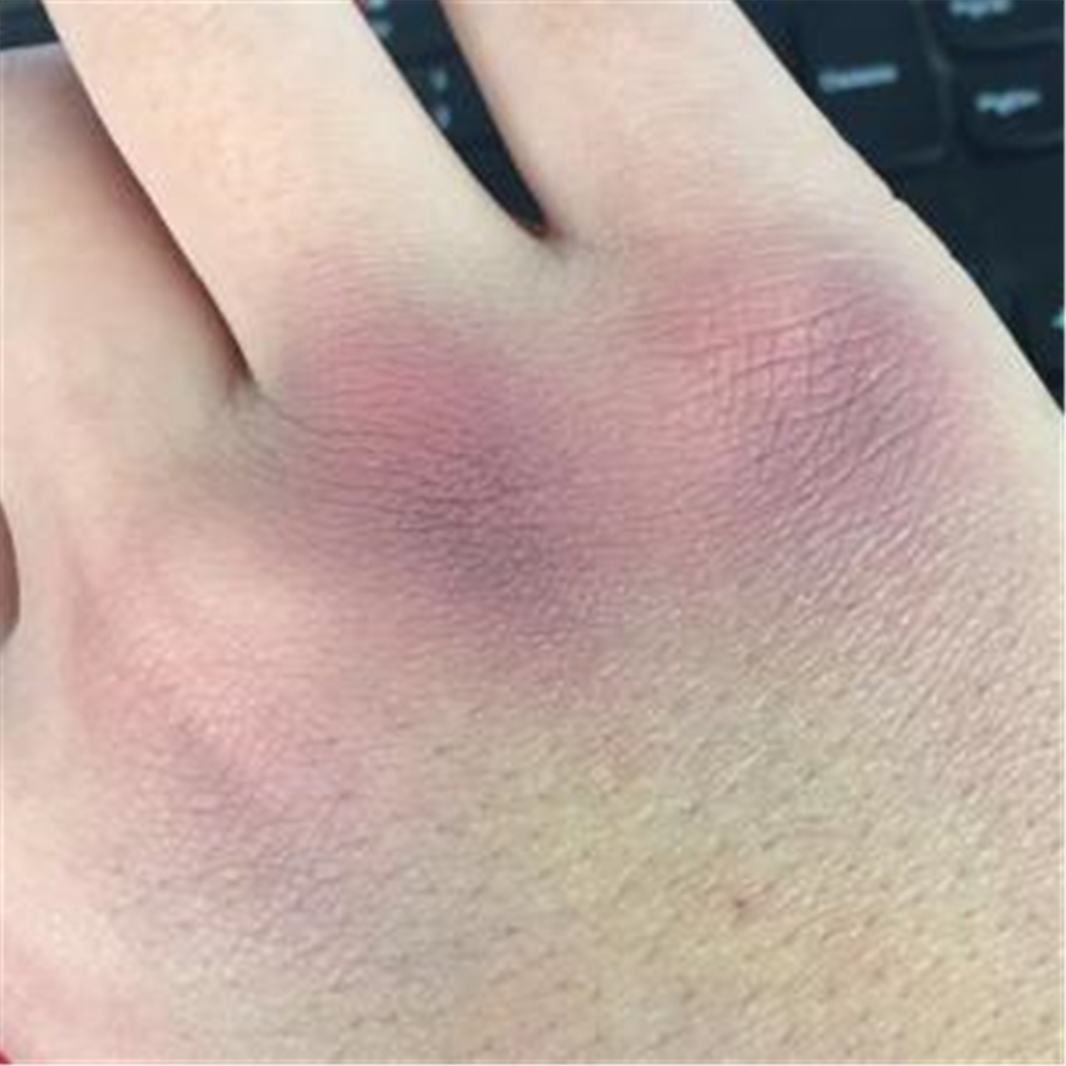 宝宝出生后屁股上为何有"淤青"?有必要治疗吗?一文讲清