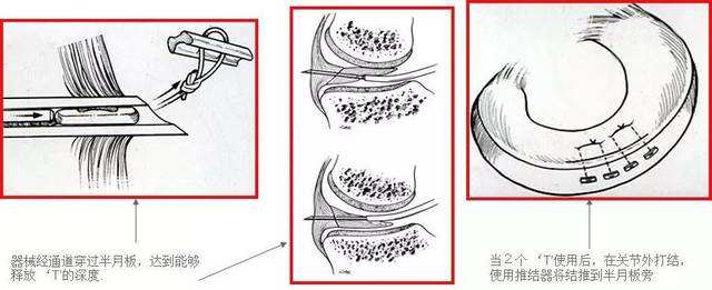 半月板损伤要缝合还是切除？哪种手术方式好？听听医生怎么说