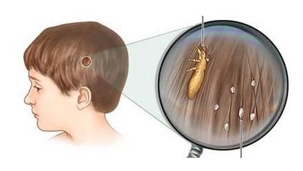 小孩头上长虱子怎么去除,长虱子的原因和防治方法