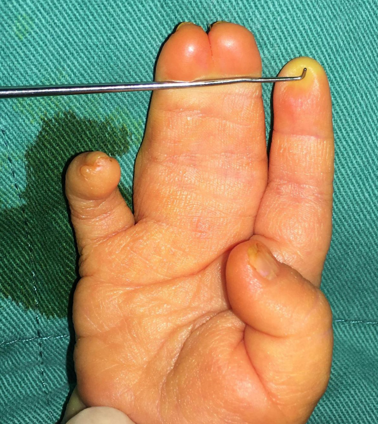 并指畸形常见问题解答及手术案例合集