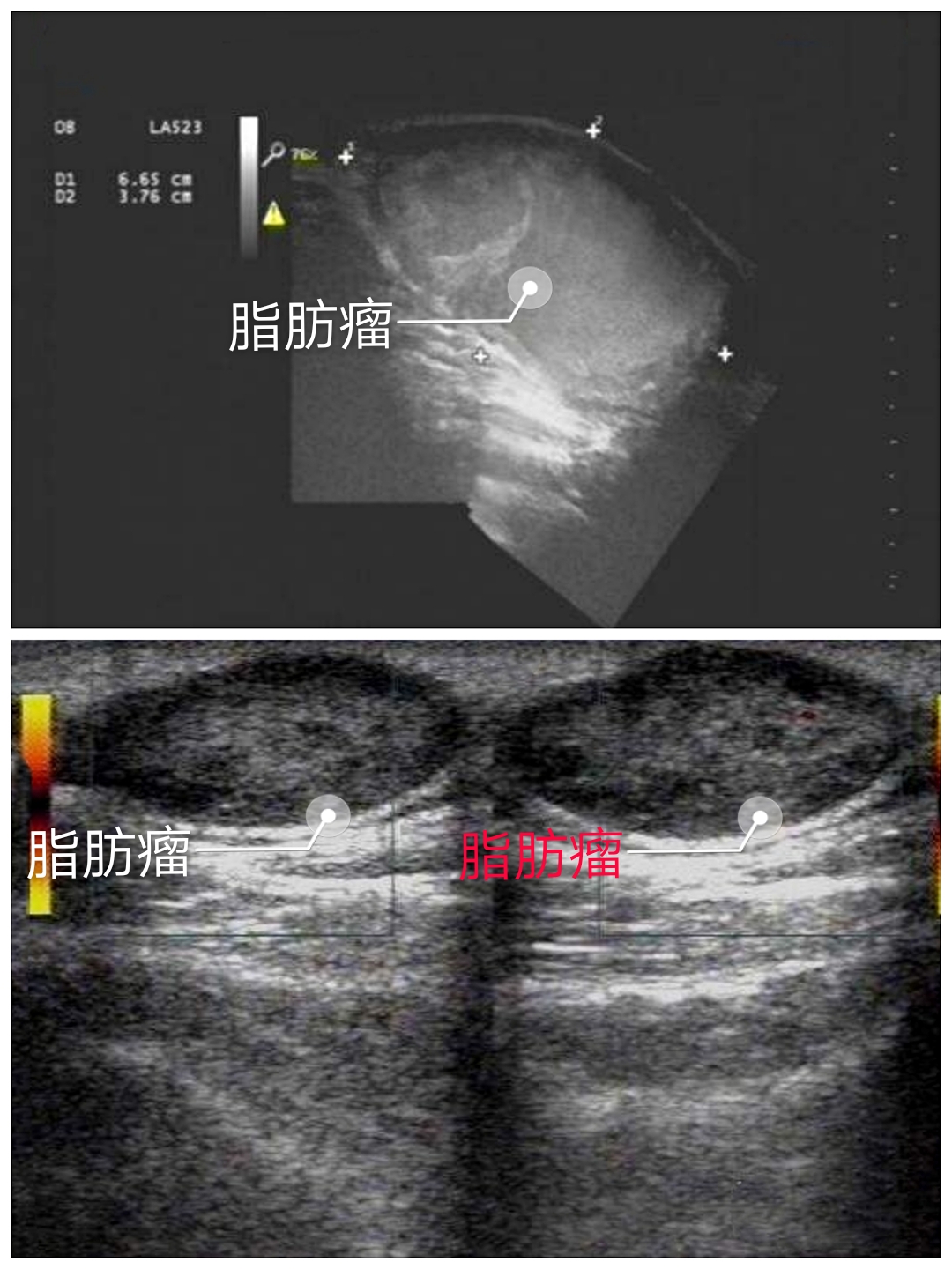 皮下脂肪瘤形成原因是什么？会癌变吗？