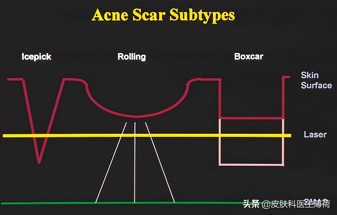 别只知道做激光了！医生说：这样祛痘坑省钱又科学