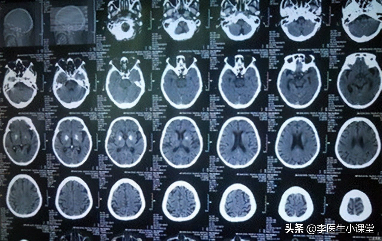 40岁王女士脑CT、核磁检查都没问题，就能排除脑转移？千万别大意