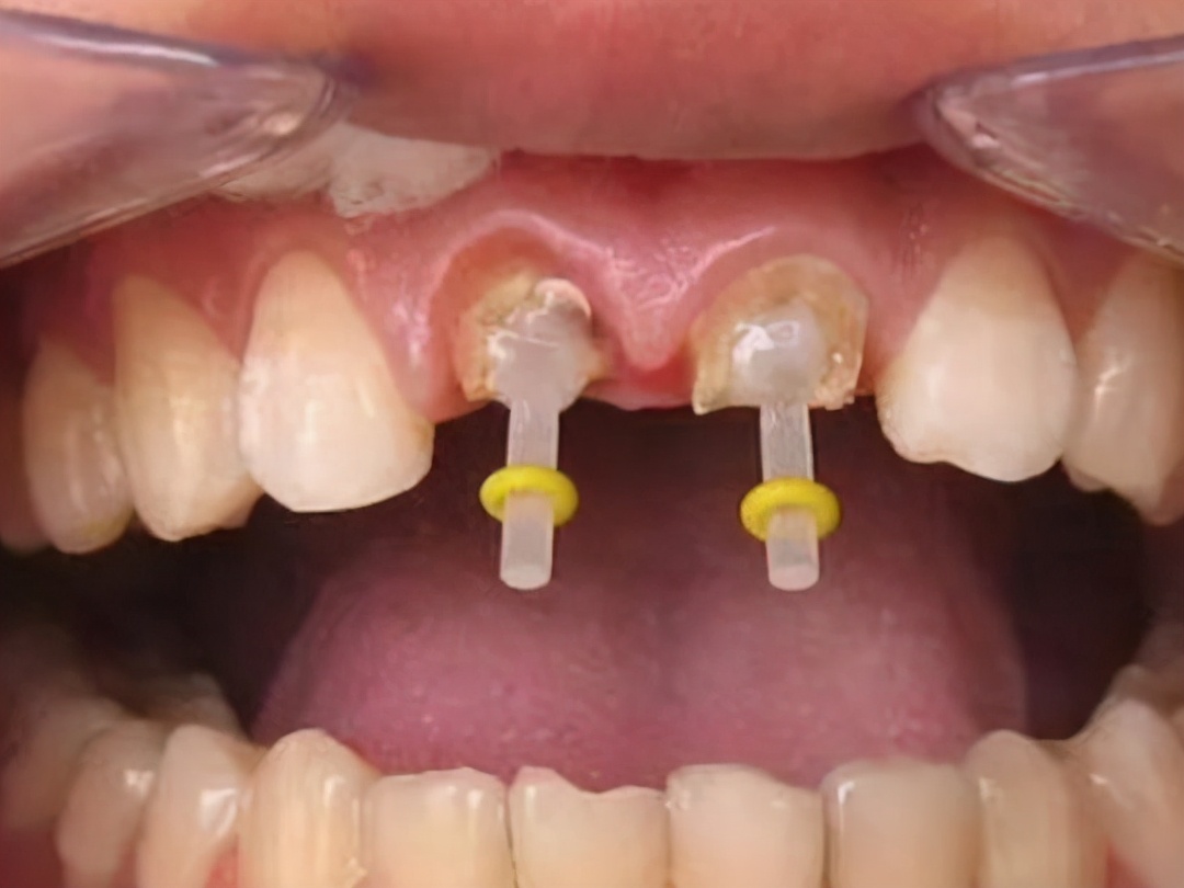 聚合瓷遮色铸造桩在前牙美学修复中应用 1 例