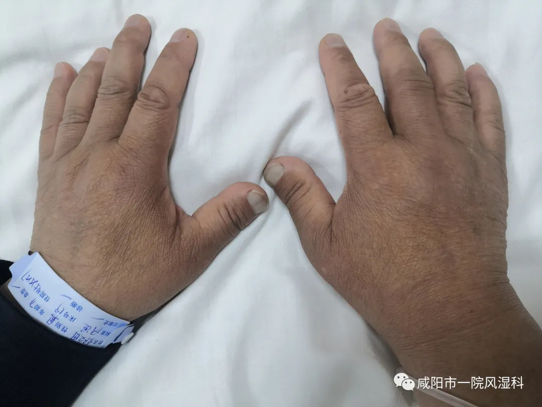 咸阳市第一人民医院:间质性肺炎病因不明?谨记排查风湿性疾病