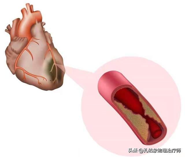 肩周炎是导致肩痛的原因，结果大家都进入误区，咋不想想其他病因