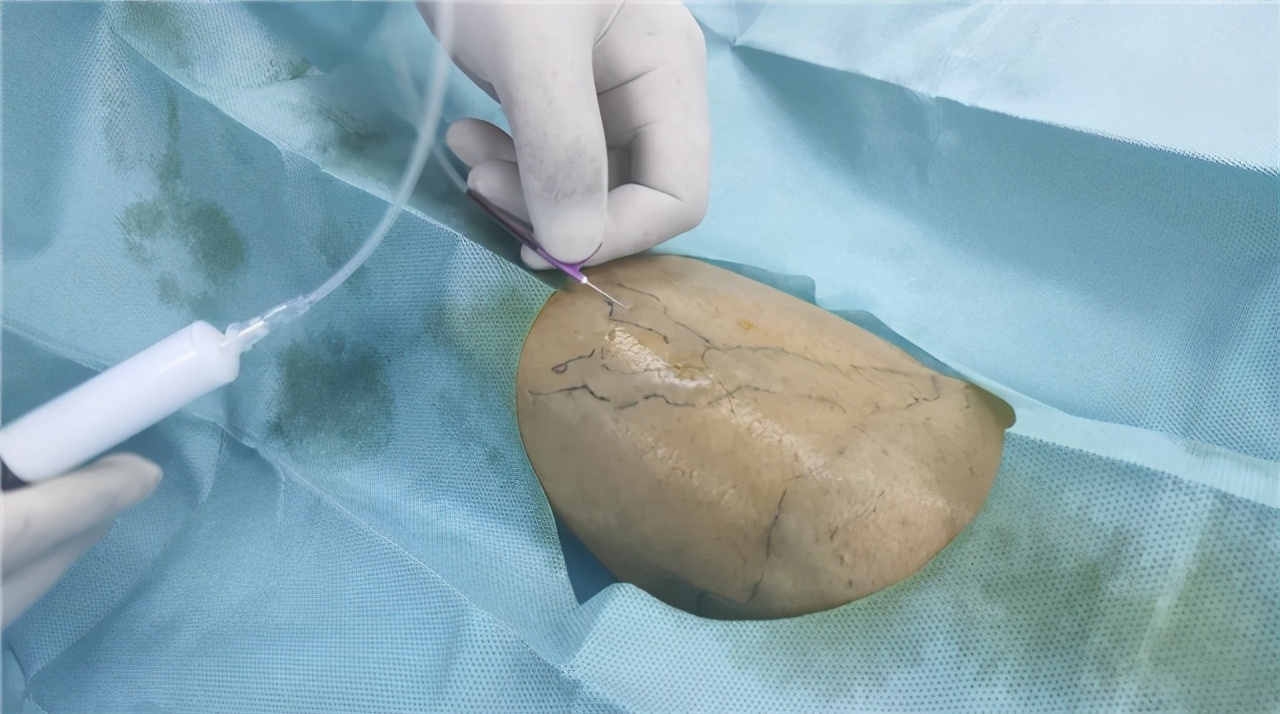 肛门长了个"小肉球",是痔疮还是尖锐湿疣?教你怎么区分