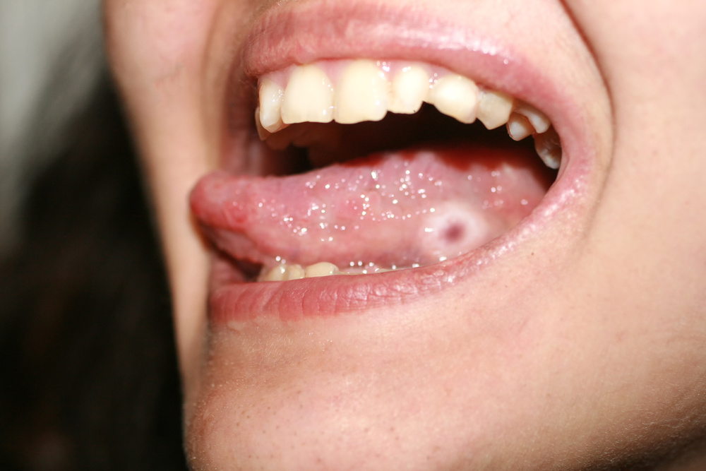 舌头上溃疡怎么治图片