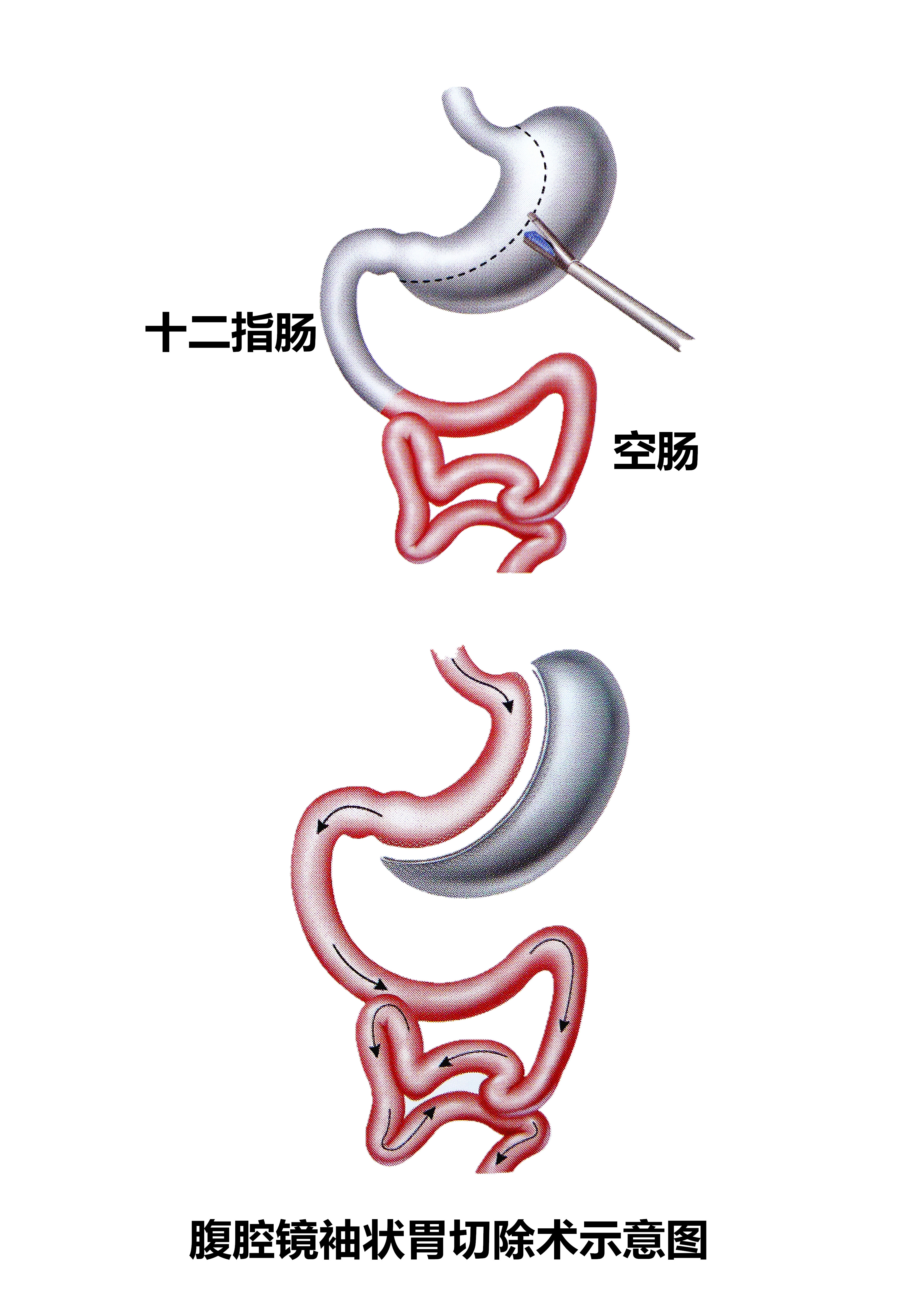 切掉大半个胃，只为了治疗糖尿病？减重手术治疗糖尿病可靠吗？
