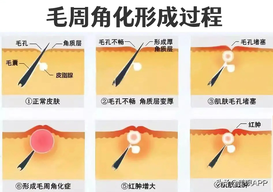 毛周角化的形成过程跟长痤疮的过程很类似,区别就在于毛周角化的皮脂