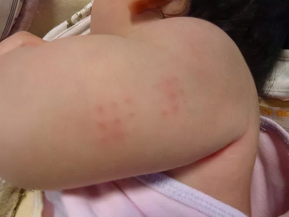 卡介苗正常疤痕图片(日本女孩令人费解的潮流) - 赤虎壹号