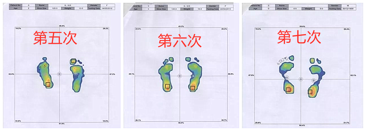 为什么我的孩子有副舟骨疼痛？孩子走路总觉得疲劳是怎么回事？