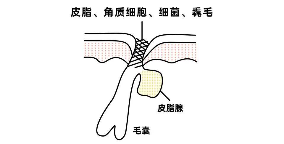 黑头究竟要怎么去？我们拔出并放大了四种类型的黑头