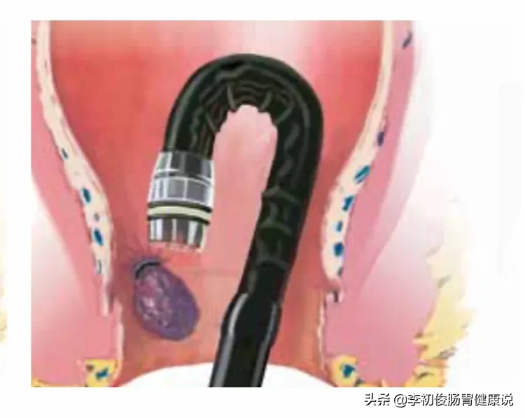 一次肠镜操作,一举三得同时完成肠道检查、套扎止血、消除内痔!