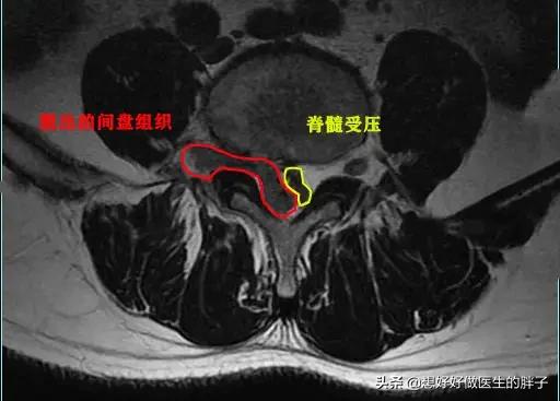 CT发现腰突、椎管狭窄、骨刺先别怕！医生：抛开症状谈检查不靠谱