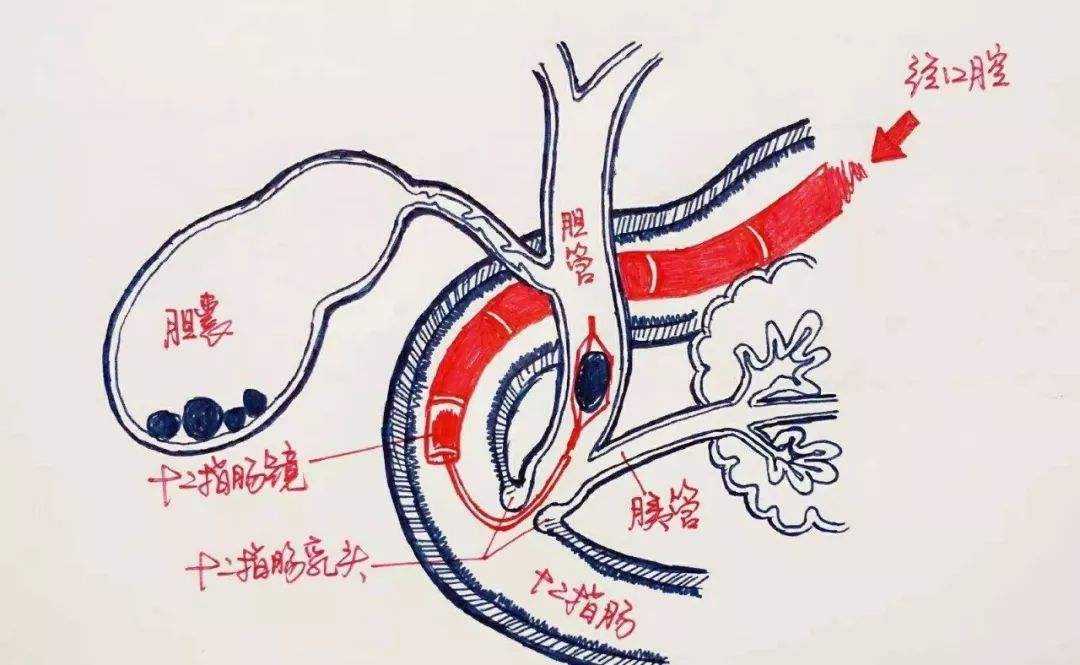 身为炎症却致命,别小看急性胰腺炎,5大病因4个预防措施在这里