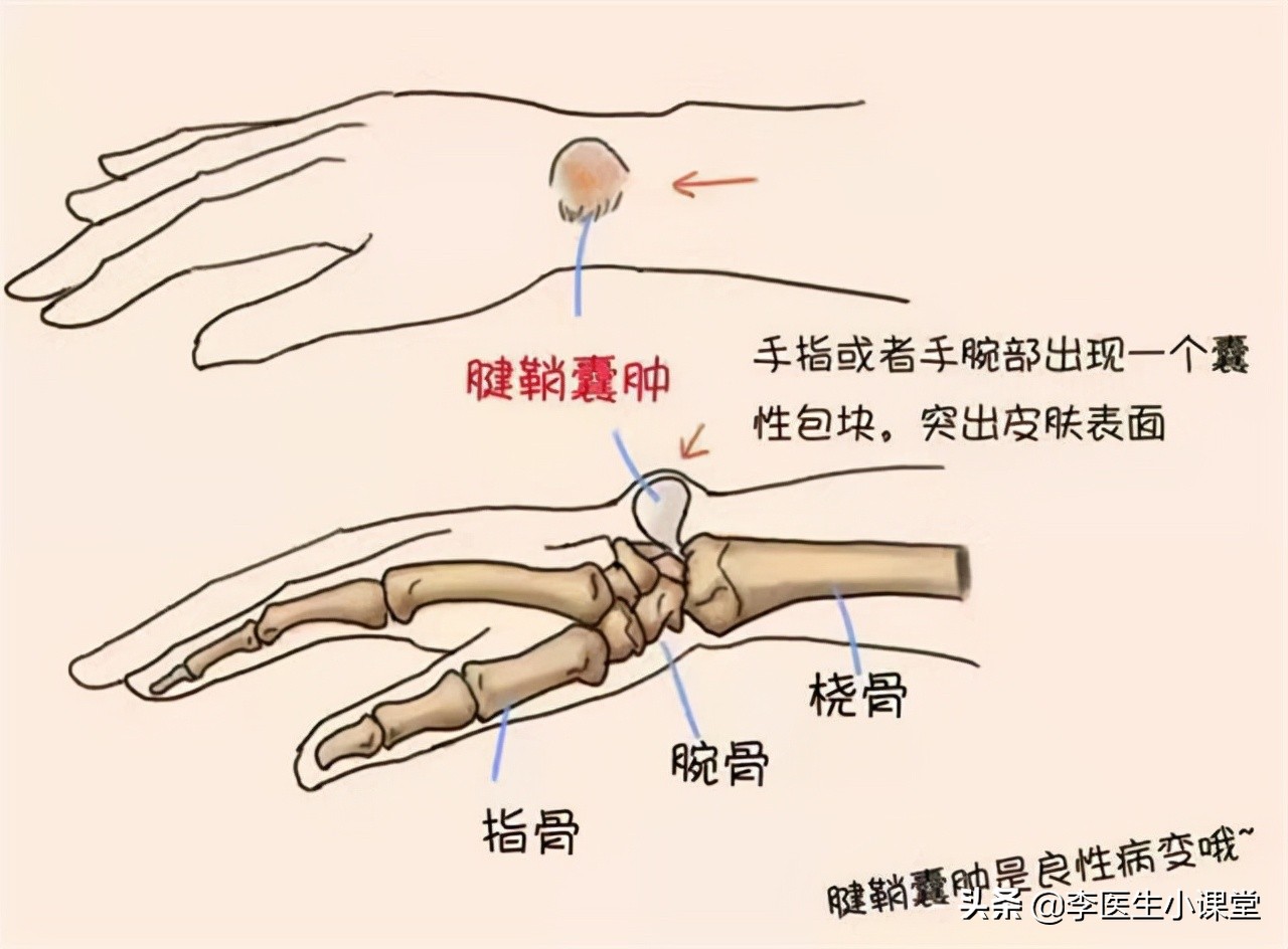 女性50岁之后，极易遭受腱鞘炎的折磨，为什么？如何治疗？