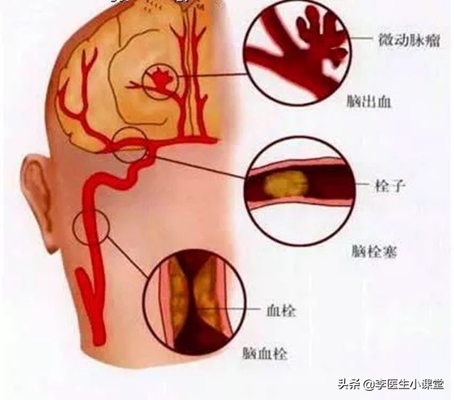 女子头痛晕倒入院，确诊脑出血，医生：5症状出现一个，就要警惕