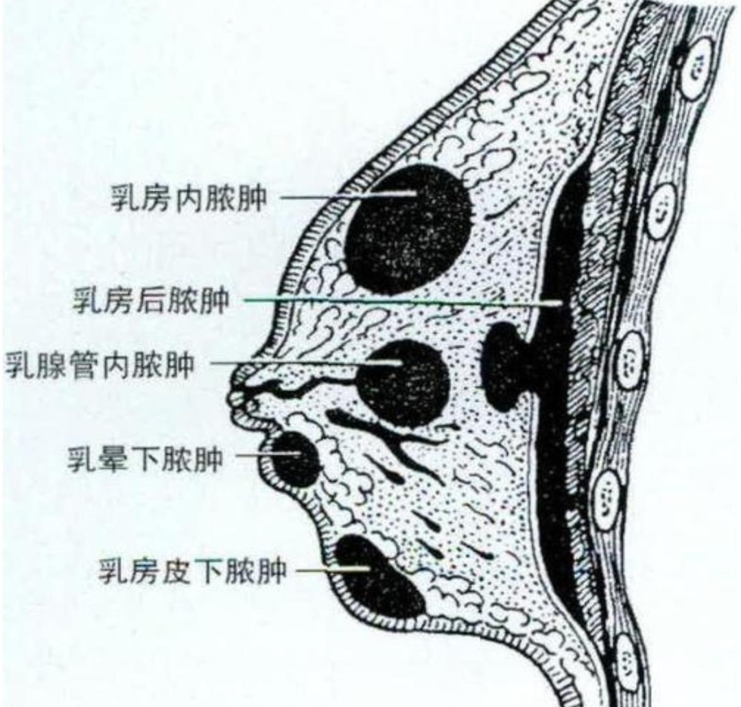 急性乳腺炎为何哺乳期多发?