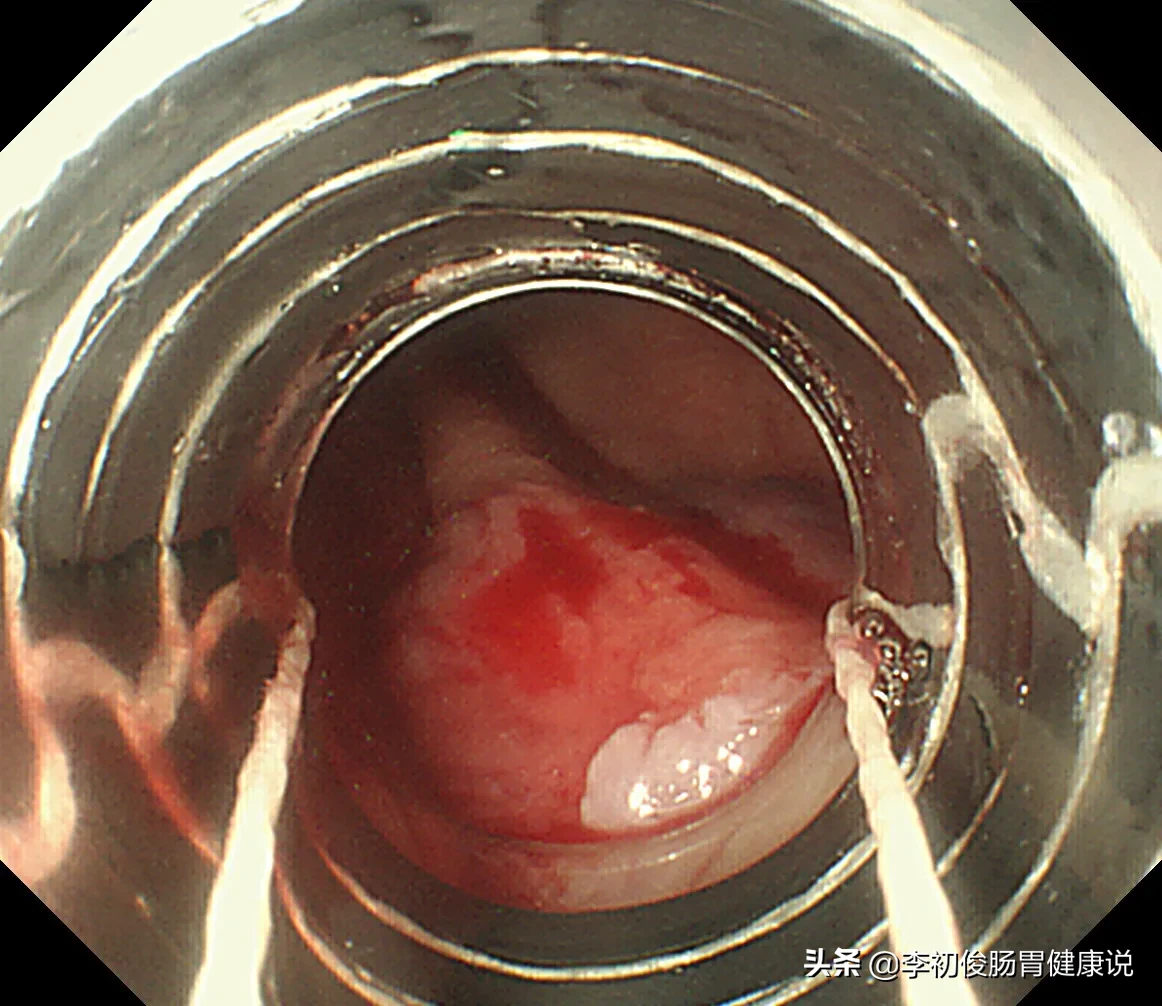 一次肠镜操作，一举三得同时完成肠道检查、套扎止血、消除内痔！