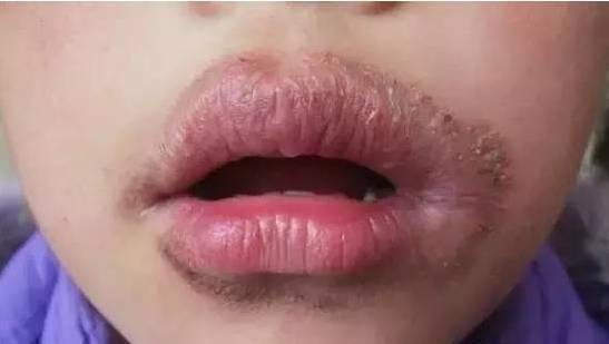 嘴唇又起皮了，干燥皲裂很难看，别舔别咬，医生告诉你该怎么办
