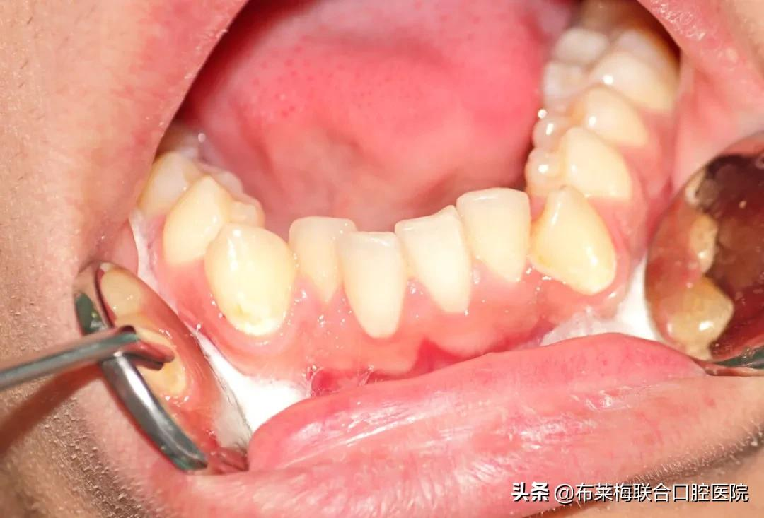 牙齿矫正,你所关心的那些问题