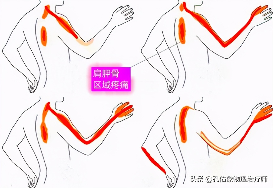 后背、肩胛骨内侧缘疼痛，是怎么回事？该如何处理？给您讲清楚