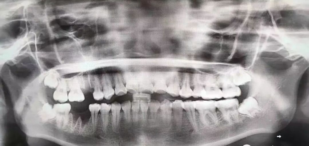 拔两颗牙收费超两万？你所不知道的智齿收费