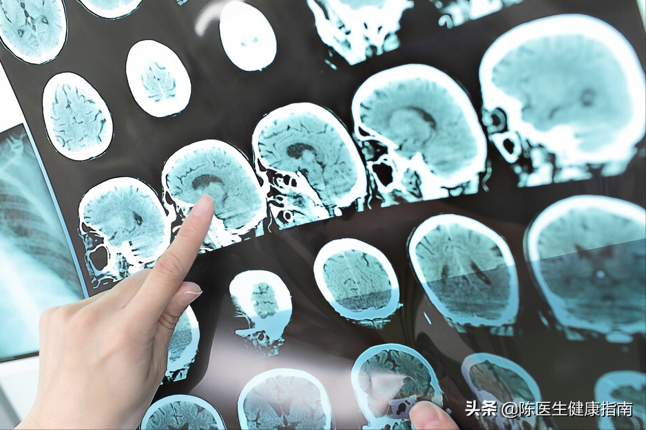 为什么中国脑梗越来越多？医生：除了补充叶酸，做好这3点更重要