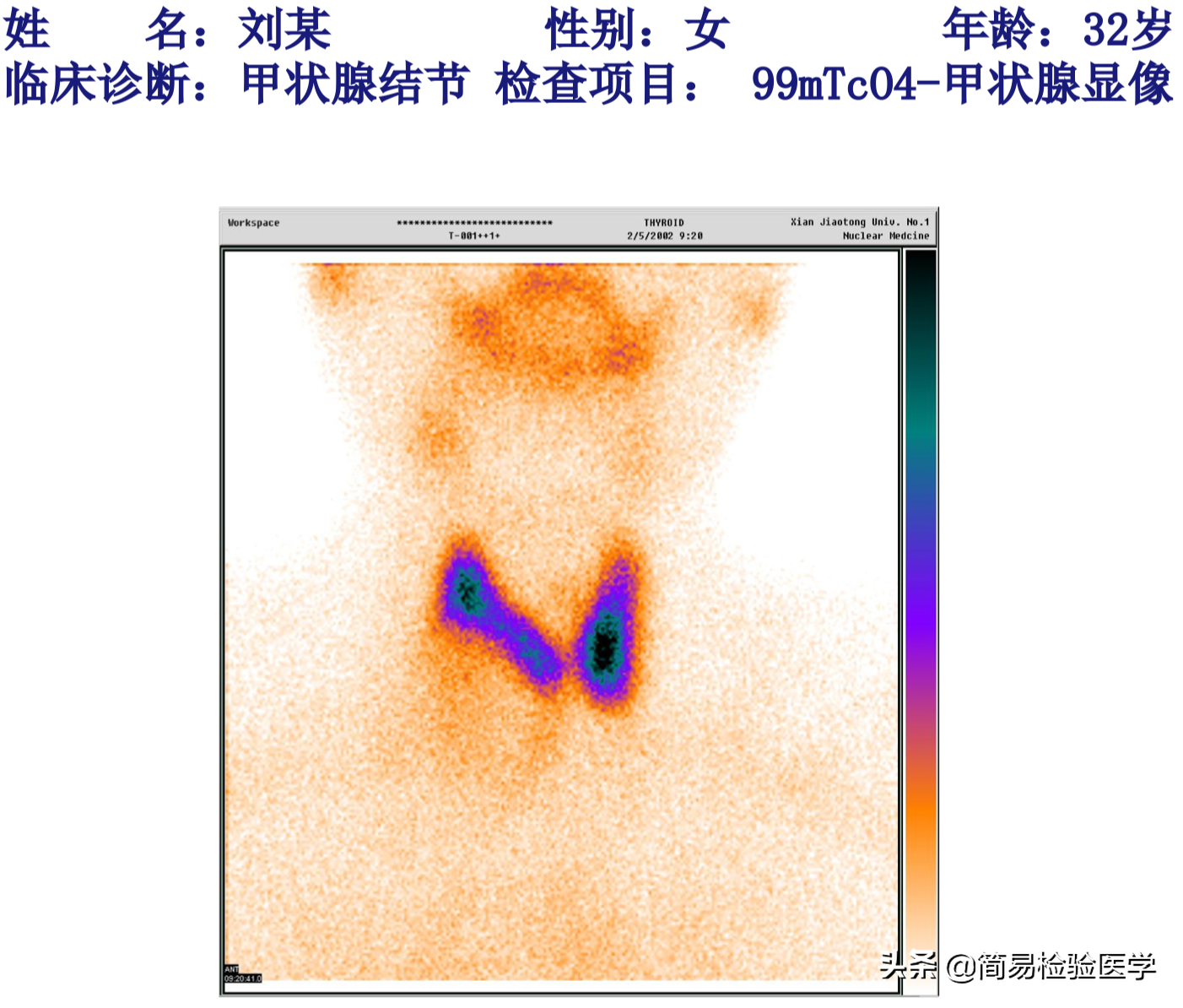 什么叫放免法甲功九项(轻松看懂甲状腺功能检测（思维导图 顺口溜）)