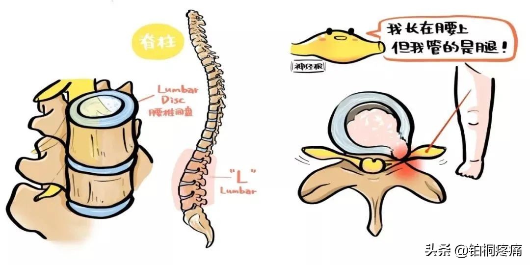 明明是腰椎间盘突出，为啥会腿疼腿麻？