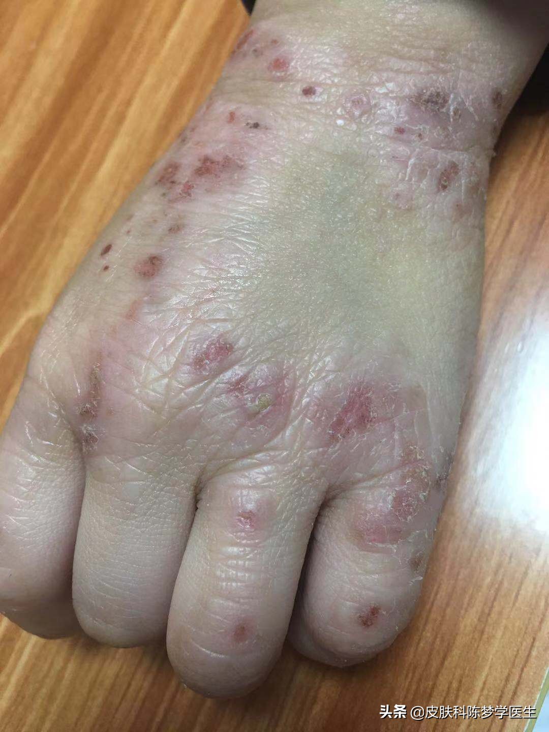 青少年湿疹擦什么药好(湿疹,我该拿什么拯救你?) - 趣味头条
