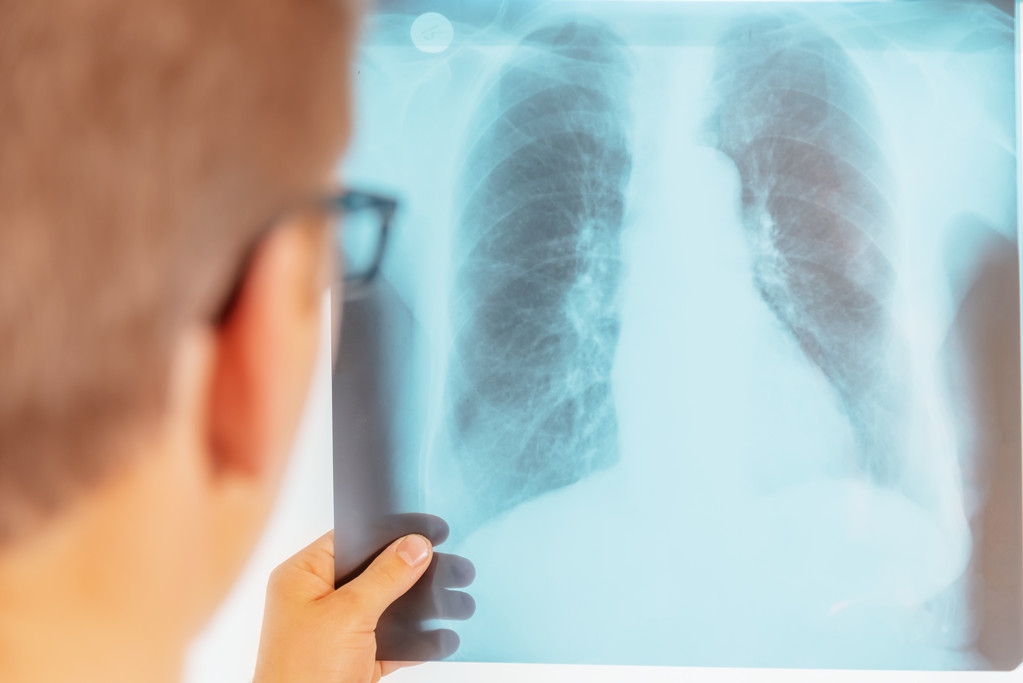 肺部X光扫描有阴影就是肺癌？医生：不一定，有可能是这4种病