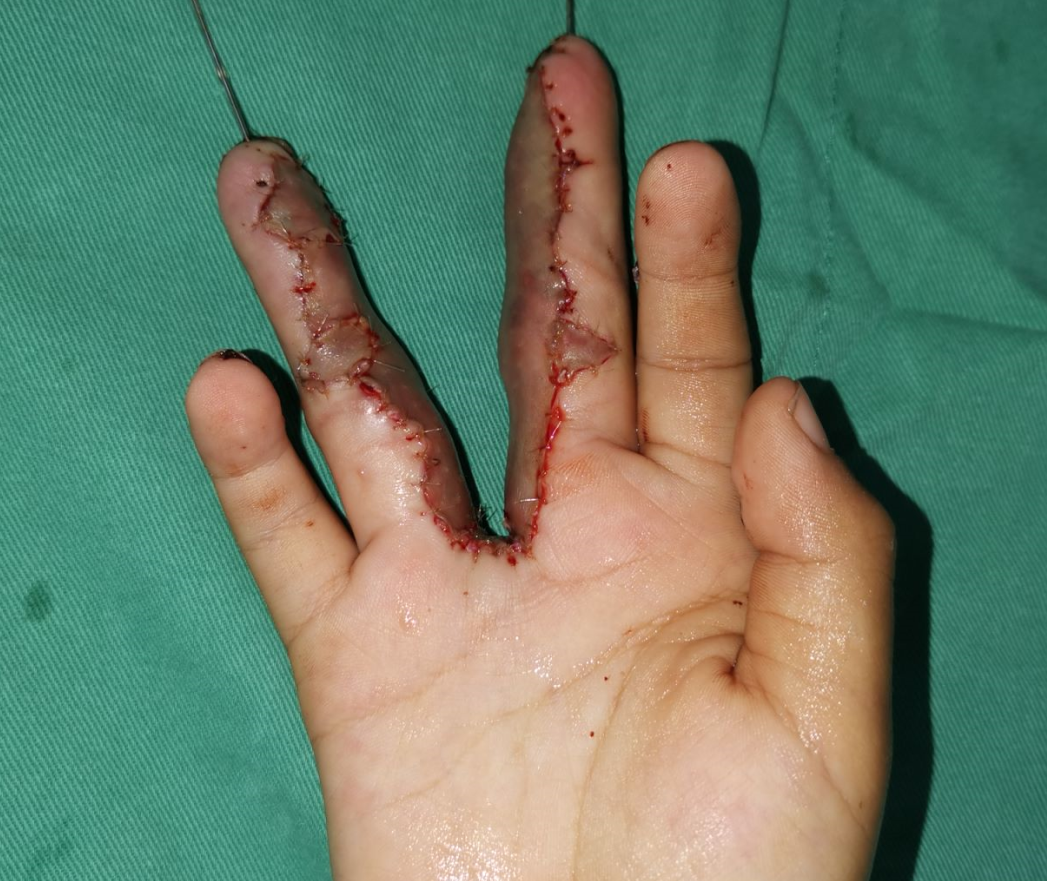 不过家长也不要太担心,因为指蹼爬移并不是所有的并指宝宝都会出现.