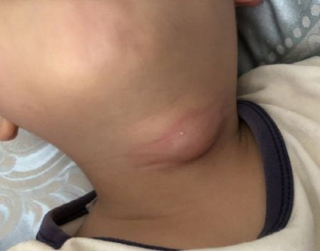 宝宝脖子有"小孔",当心是鳃瘘!