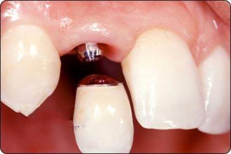 大连齿医生科普 种植牙5大类型的危害