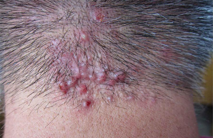 腿上毛囊炎的症状图片(项部瘢痕疙瘩性毛囊炎) - 赤虎壹号