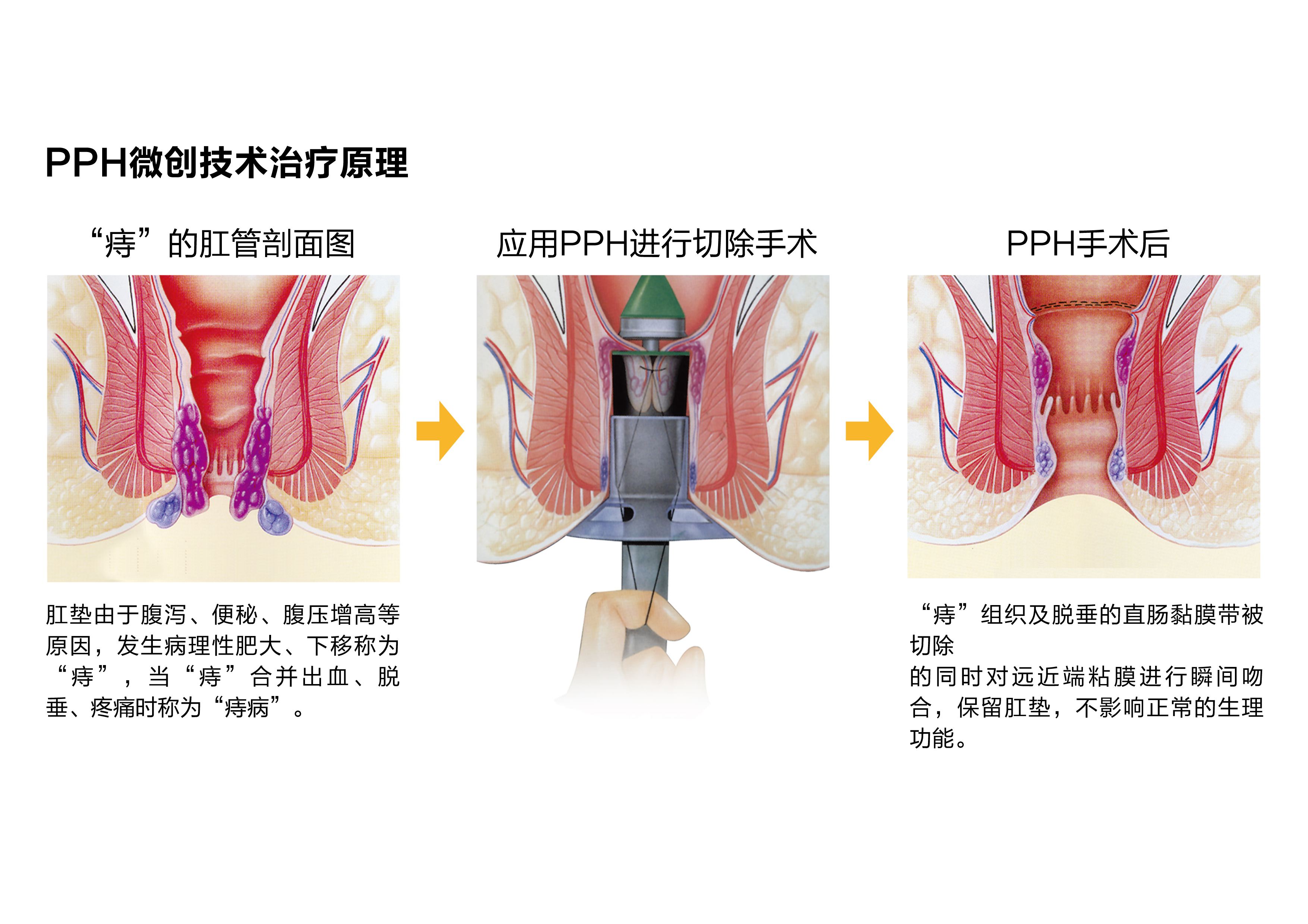 痔疮可以自愈吗？有哪些治疗手段？医生告诉你答案