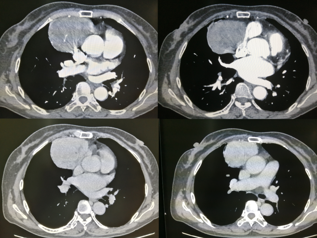 最常见的胸腺瘤,这些诊断要点要知道
