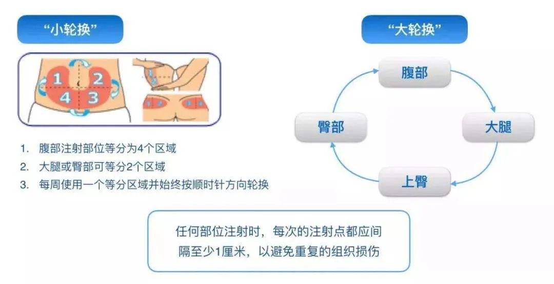 打针的位置有讲究